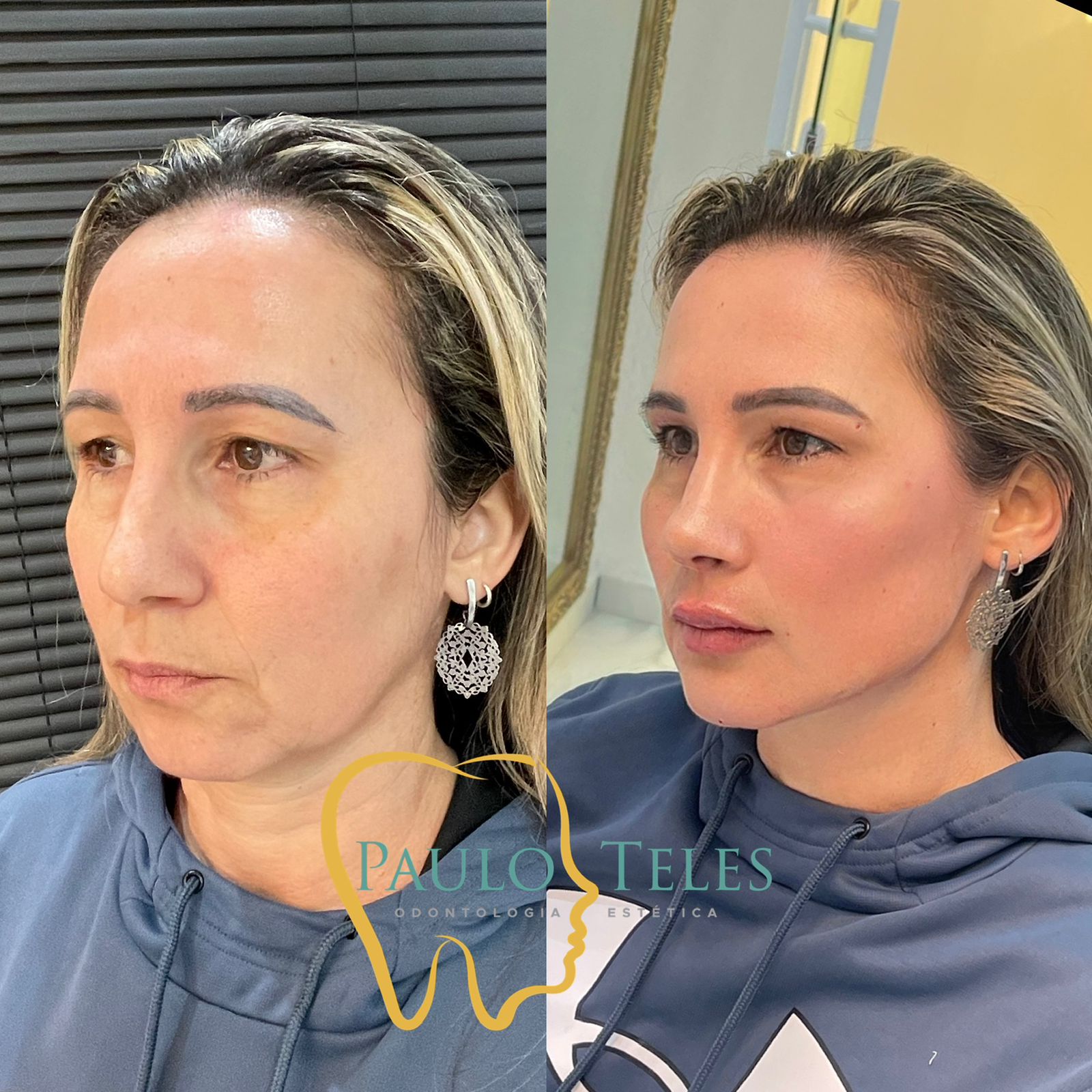 Preenchimemto facial Dr.Paulo Teles, Clínica de estética são paulo Tatuapé