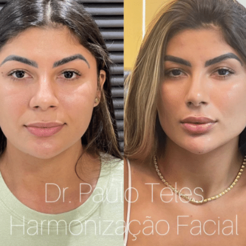 Harmonização facial feminina Full Face. 😍🙏💉 @ São Paulo