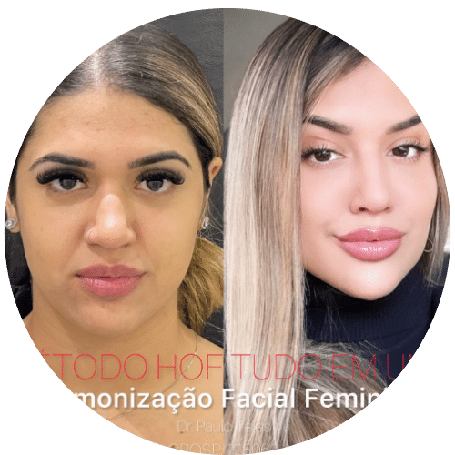 harmonização-feminina