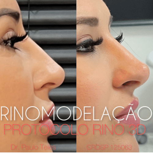 rinomodelação-em-são-paulo