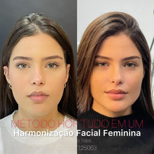 Harmonização facial feminina Tatuapé