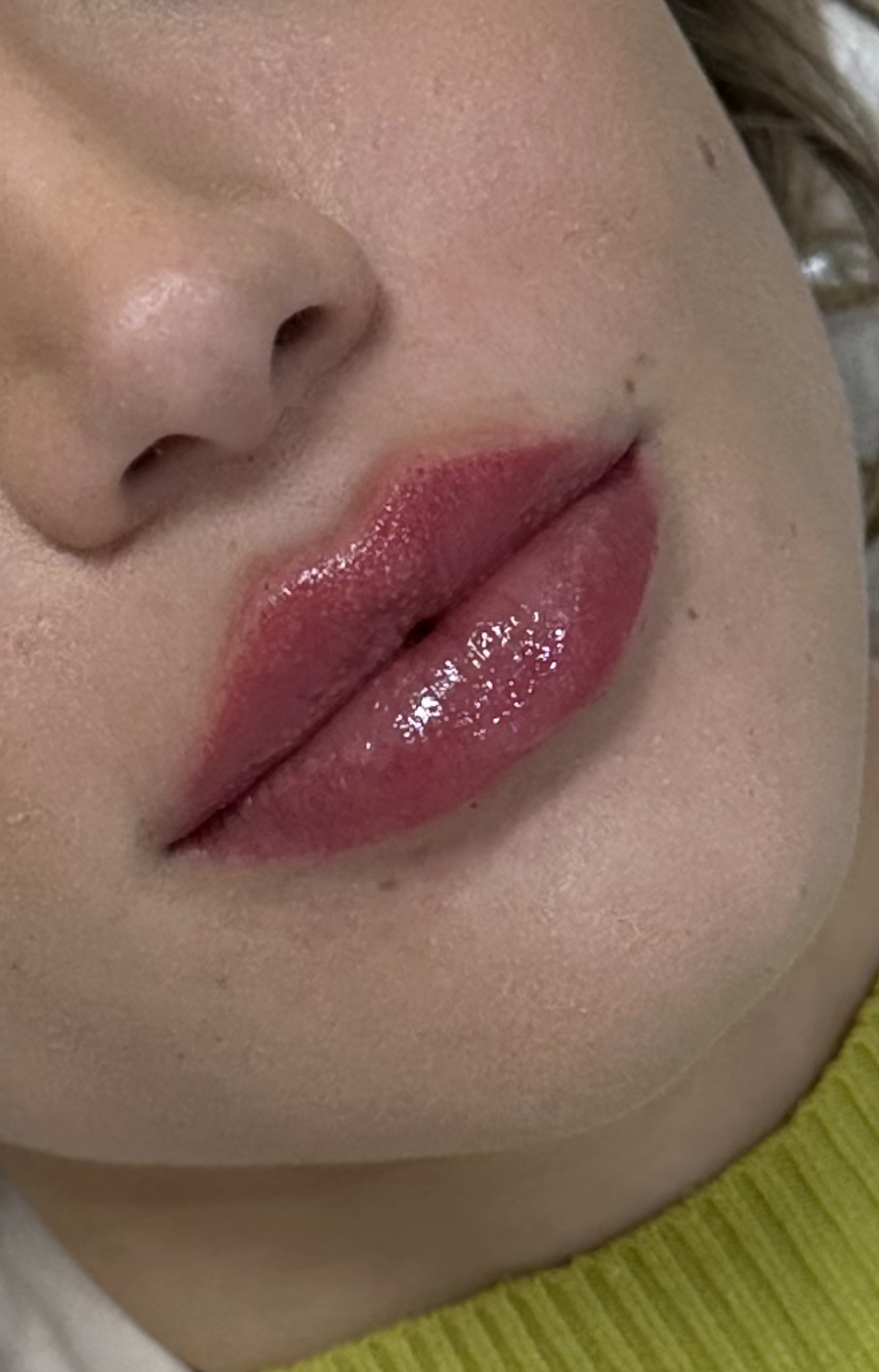 Preenchimento labial