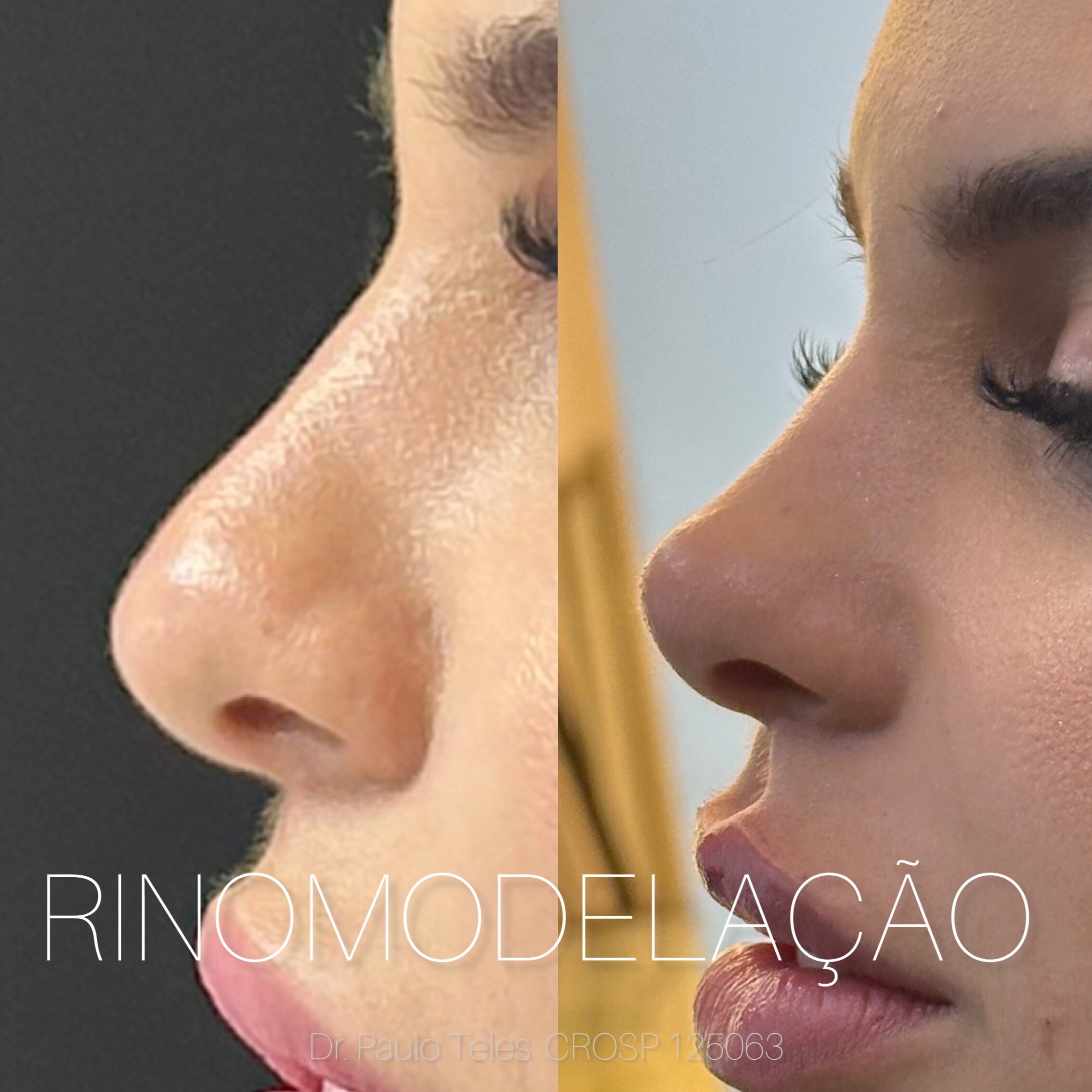 Rinomoledação